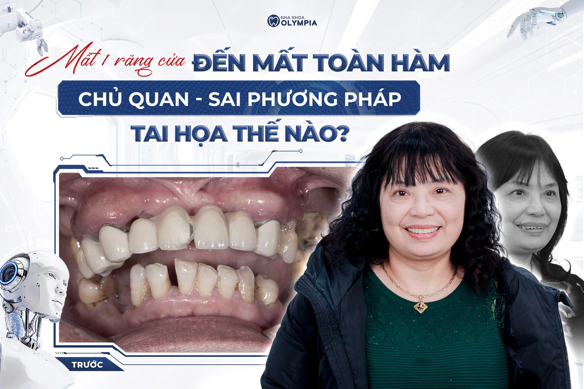18 tuổi mất răng cửa làm cầu răng sứ và kết quả mất hết răng
