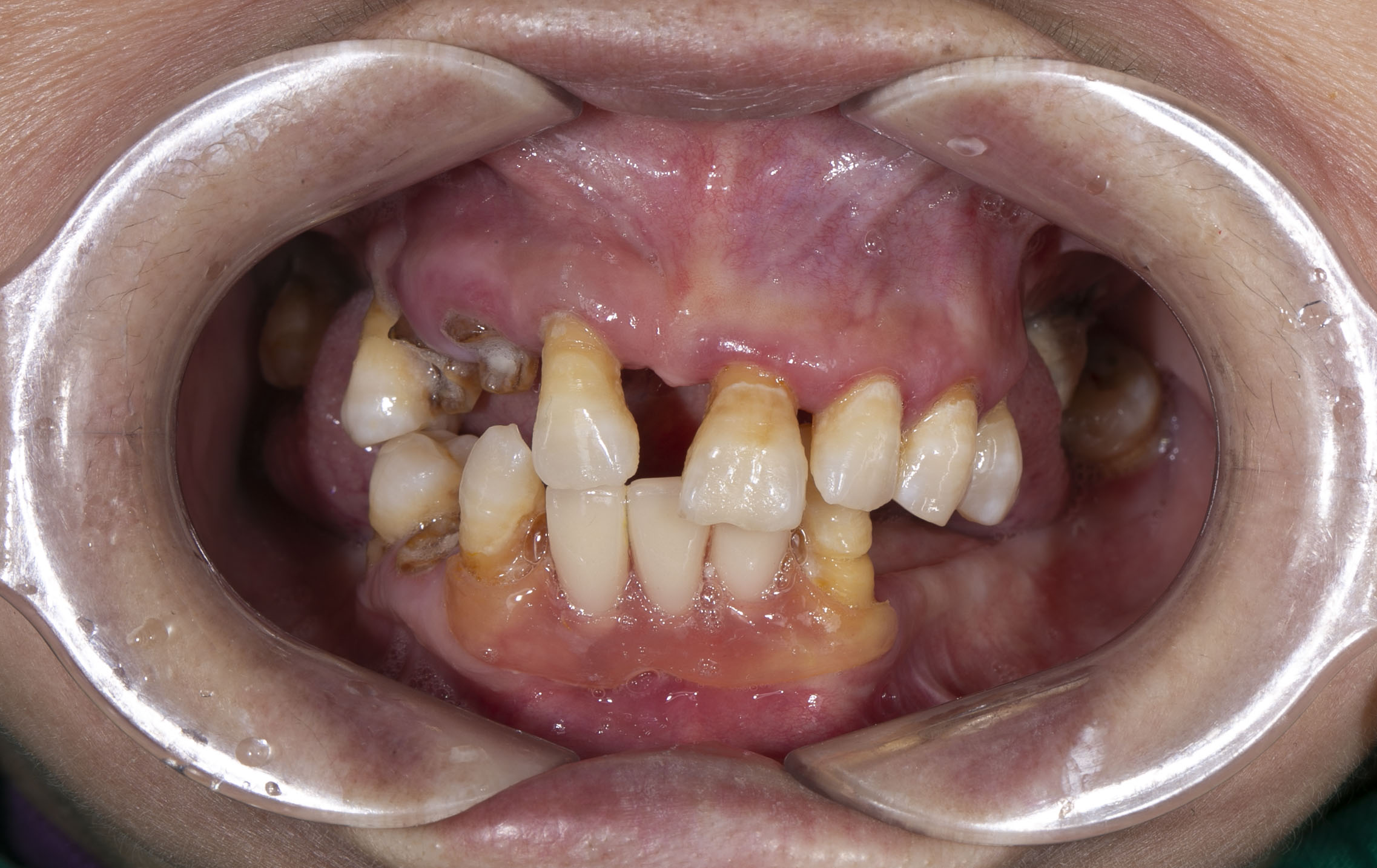Giải pháp 1: Hàm giả tháo lắp (Răng giả nhựa truyền thống)