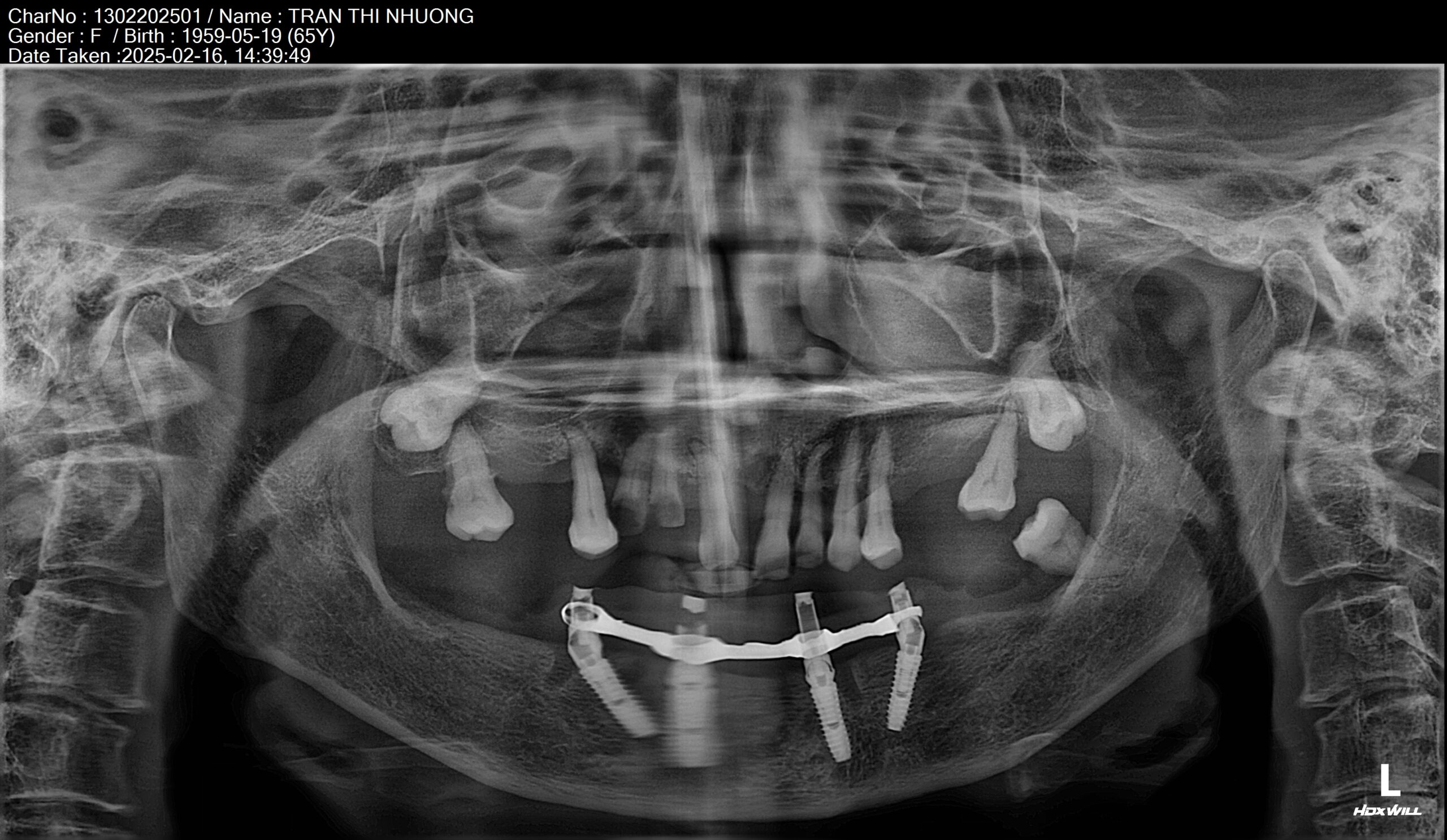 Cấy Implant 4 trụ cho hàm dưới để phục hồi lại chức năng ăn nhai