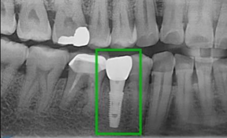 Hình ảnh phim X-Quang thực tế cấy trụ Implant Superline của Mỹ
